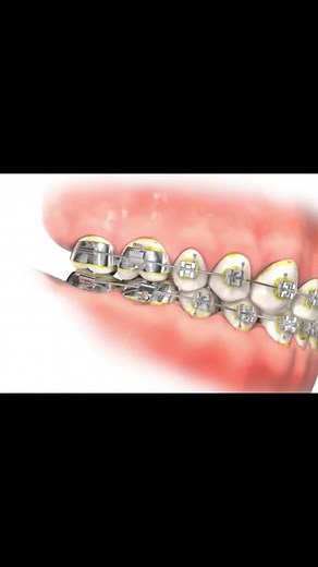 Dental Braces Adjustment Procedure Explained