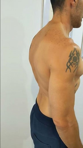 Scheurmann's disease, an exaggerated Thoracic kyphosis. ‪@aubreymoniephysio‬