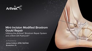 Mini-Incision Modified Brostrom Gould Repair Utilizing the Arthrex® Brostrom Repair System and 2.9 mm DX PushLock®