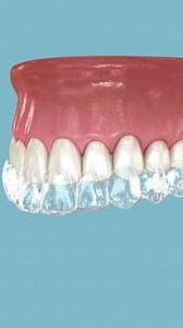 3D Animation of Clear Aligner Straightening and Whitening Teeth