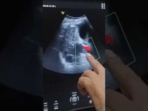 Portal vein thrombosis with liver cirrhosis 