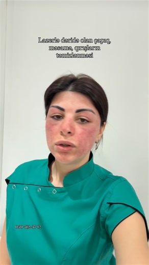 Frakcional lazer Co2’ 1 nömrəli Mütəxəssis on Instagram: "🔻Sızanaq izləri 🔻Cərrahiyyə izləri 🔻Yanıq izleri 🔻Hamiləlik və doğuşdan sonra izler 🔻Dəri qırışları və dəri sıxılması 🔻Yaş və günəş ləkələrinin təmizlənməsi 🔻Hamiləlik lekesi (melazma) Ətraflı məlumat üçün 0507123712 nömrəsinə şəkil göndərin, sizə cavab veriləcək. Əlaqə nömrəmiz: 📲 +(994) 50-712-37-12 #frakcionlazer # frakcion #emeliyyat #gözəlliksalonu #gözəllikmərkəzi selamunaleykum . kadirezildi bimaktuel aktuelurunler aktüel e