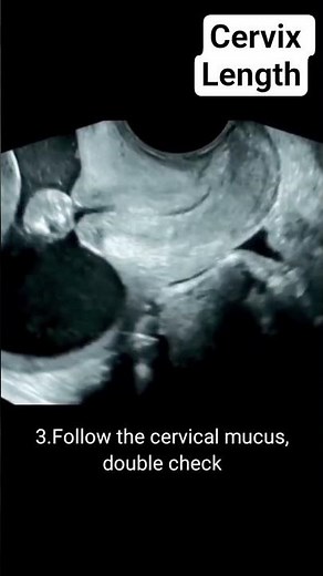 Cervical length measurement on ultrasound #radiology #ultrasound #cervix