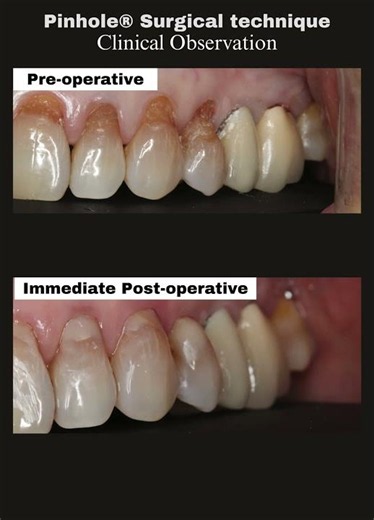 The one-year follow-up matters. ⏳🦷#pinholesurgicaltechnique #gumrecession #dentaleducation