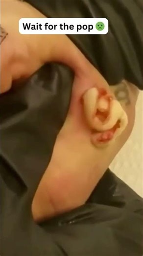 Large Blackheads Extraction Big Cystic Acne Blackheads&Whiteheads Removal Pimple Popping #1058 2026