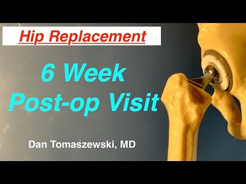6 Week Post-op Visit after Hip Replacement Surgery