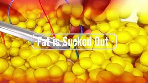 Mr. Ahmed told us, he had tried all kind of nonsurgical treatments, spent time-consuming hours in long, painful sessions with no results at all. When I consulted the plastic surgeon at Elite Style, he explained to me that I had deep Fat, which will never get results from Nonsurgical treatments. He offered me In-office LIPO in a single Session. I was scared and was not sure. After my research, I got to know he has done many such procedures, and it is safe. The doctor reassured me, it's just 1 hou