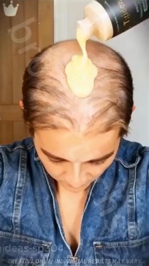 🌿 Μια νέα εποχή ενάντια στην τριχόπτωση. Η Kherastine είναι ο επαγγελματικός ορός μαλλιών που δρα απευθείας στη ρίζα, μειώνει την πτώση, ενισχύει την πυκνότητα και επαναφέρει τη δύναμη και τη ζωτικότητα στα μαλλιά — χωρίς ερεθισμούς, χωρίς επιθετικές θεραπείες. 💧 Από τις πρώτες κιόλας εφαρμογές, η συμπυκνωμένη σύνθεση θρέφει σε βάθος το τριχωτό της κεφαλής, διεγείρει τη μικροκυκλοφορία και ενδυναμώνει τον θύλακα της τρίχας, εκεί όπου γεννιέται το μαλλί. 🚫 Χωρίς δαπανηρές λύσεις. 🚫 Χωρίς περί