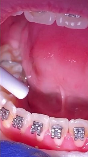 How to stop teeth from shifting after braces? Braces On - Toothtime Family Dentistry New Braunfels