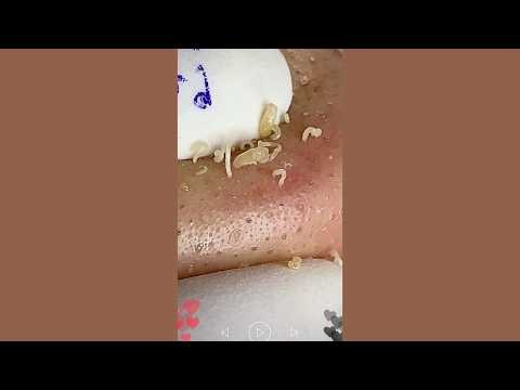 Skincare | Blackheads Removal #855 #tweezers skincare #blackheads blackheads