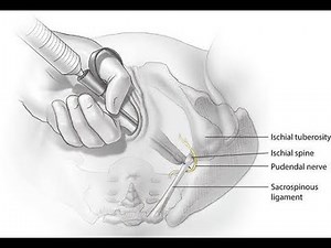 Best location to deliver anaesthetia to perform pudendal nerve block (How to Locate Pudendal Nerve)