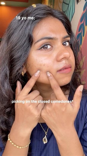 Picking on your acne😢#acne #acneproneskin #skincare #explorepage #viralvideo #shorts #fyp #pov