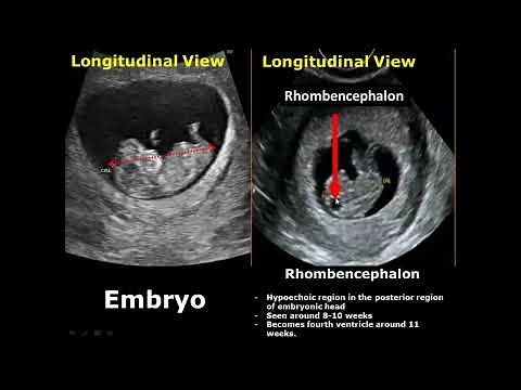 First Trimester & Ectopic Pregnancy Ultrasound Image Appearances