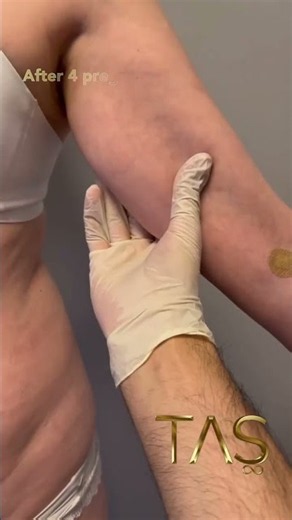 Full Body Contouring: Before and After | 5th Plastic Surgery Course | Prof. Dr. Suleyman Tas