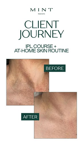 Client Journey Spotlight ✨ We are thrilled to share these incredible results treating Poikiloderma of Civatte! This harmless but stubborn skin condition, often seen on the neck and chest, is caused by years of sun exposure and results in pigmentation and redness. Our fantastic client committed to a series of IPL treatments combined with a personalised at-home skincare routine suggested by Louise, and the transformation speaks for itself! The IPL has effectively targeted the red and brown discolo
