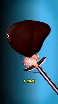 Enlarged Prostate Treatment: How TURP Is Done? (3D Animation) #prostatehealth #prostatetreatment