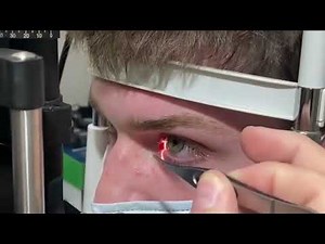 Punctal Plug Insertion