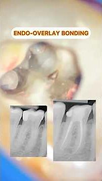 Endo Emax overlay bonding #tutorial #emax #onlay #satisfying #asmr #asmrdentist #fyp #foryou