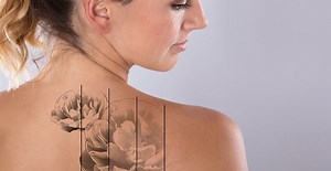 Erase Unwanted Ink with Tattoo Removal in Jacksonville Beach, FL - Laser Skin Solutions Jacksonville