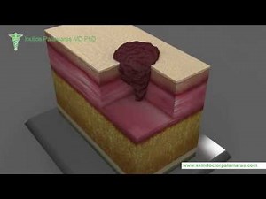 Mohs Micrographic Surgery by Dr Palamaras