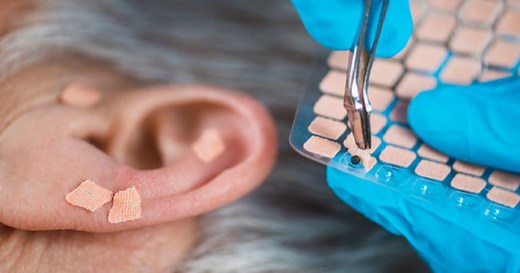 Auriculotherapy: Stimulate your ear, lose weight from your rear