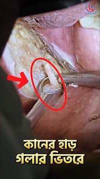 Vocal Cord Polyp and Styloid Process Surgery. | Dr Mashiur Rahman #shorts #youtubeshorts #foryou