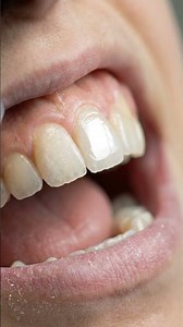 Reattaching a Broken Tooth Fragment in 5 Minutes