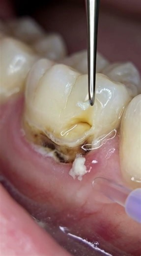 Gumline Shadow Rot Transformation #toothdecay #dentaltransformation