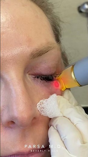 Removing Big Blue/Green Veins Around the Eyes | Orbilase Treatment | Dr. Kami Parsa