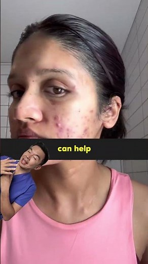 How to treat severe acne