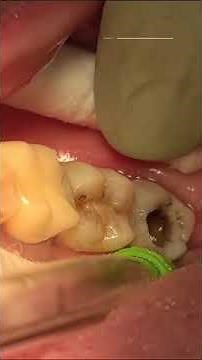 Indirect pulp Filling