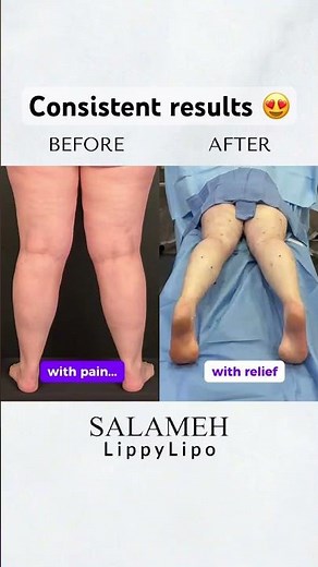 Not Fat legs… It’s a medical condition called #lipedema