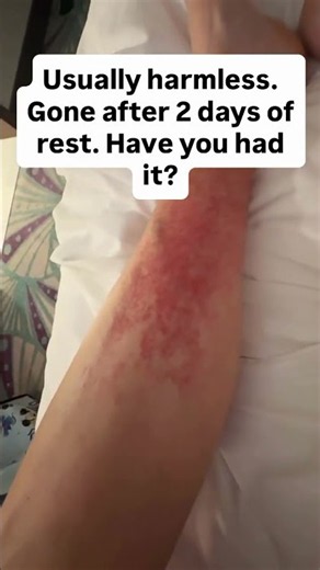 The dreaded "Disney Rash"