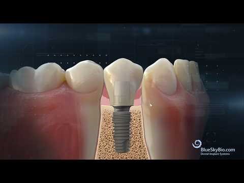 Verify Seating of Prosthetics in a Conical Connection Implant