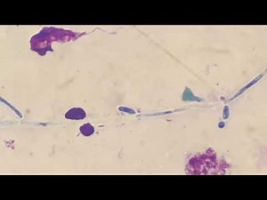 Fungal hyphae in Giemsa staining of sputum