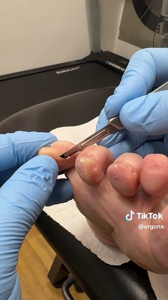 Effective Corn Removal Between Toes by Podiatrist