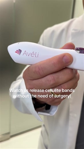 Avéli is a minimally invasive procedure that is FDA-cleared for the treatment of cellulite in the thighs, buttocks, and abdomen. Aveli can be done under local or general anesthesia. ⁣The procedure uses a handheld device to manually target and release the septa bands that cause cellulite. This results in smoother, more evenly toned skin. A single in-office treatment can result in a significant reduction in cellulite dimples. Most patients experience some soreness and bruising after the procedure,