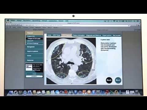 Interstitial Lung Disease HRCT Scans - Images of ILD