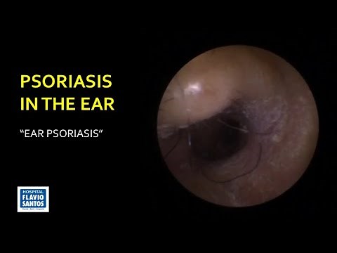PSORIASIS IN THE EAR