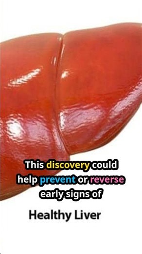 Gut bacteria trained by fiber can reverse fatty liver disease, study shows