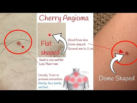 Cherry angioma - Red moles on skin