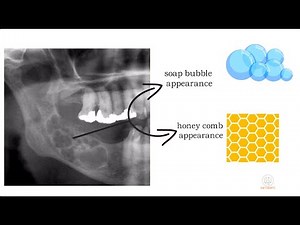 Ameloblastoma part 1