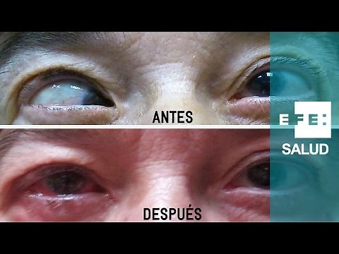 El estrabismo tiene doble solución oftalmológica