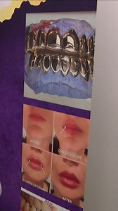 5.2K views · 21 reactions | A Milwaukee woman accused of performing dental work without a license is now at the center of a civil lawsuit. Read more: https://www.tmj4.com/about-us/lighthouse/im-scarred-for-life-woman-sues-unlicensed-fake-dentist-in-milwaukee-after-veneers-ruin-her-teeth | TMJ4 News | Facebook