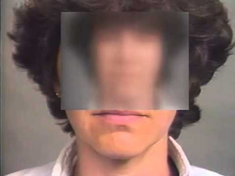 Aberrant Regeneration of the Seventh Nerve