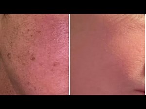 how to get rid of age spots on your face naturally and PERMANENTLY