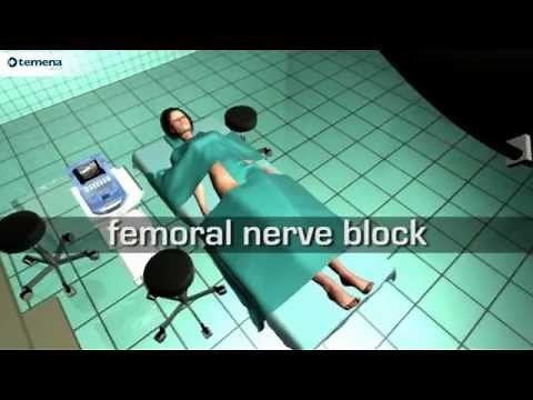 Femoral Nerve Block