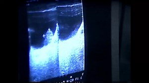 Healing Bladder Cancer Entire Footage