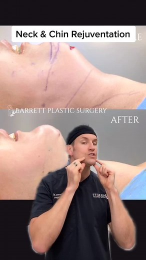 Chin Implant Cost in Sydney - Ricky Martin's Transformation