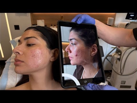 REAL PHENOL PEEL RESULTS FOR ACNE SCARS | Dr. Jason Emer